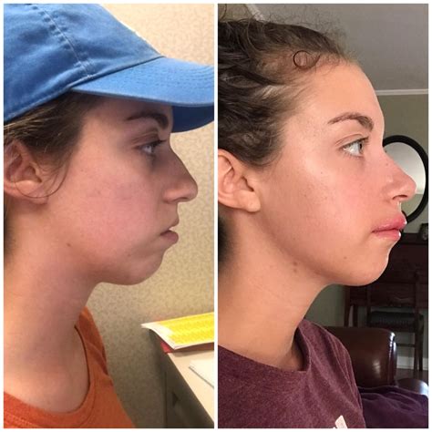 jaw surgery reddit|More.